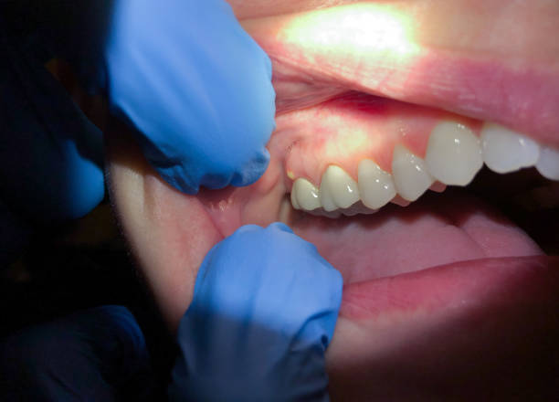 Best Dentist for Tooth Abscess  in Shell Valley, ND